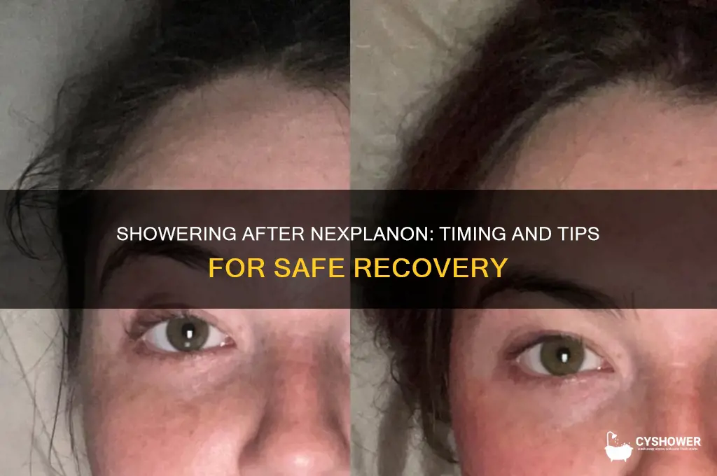 when can you shower after getting nexplanon