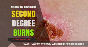 Healing Second-Degree Burns: Safe Showering Timeline and Recovery Tips