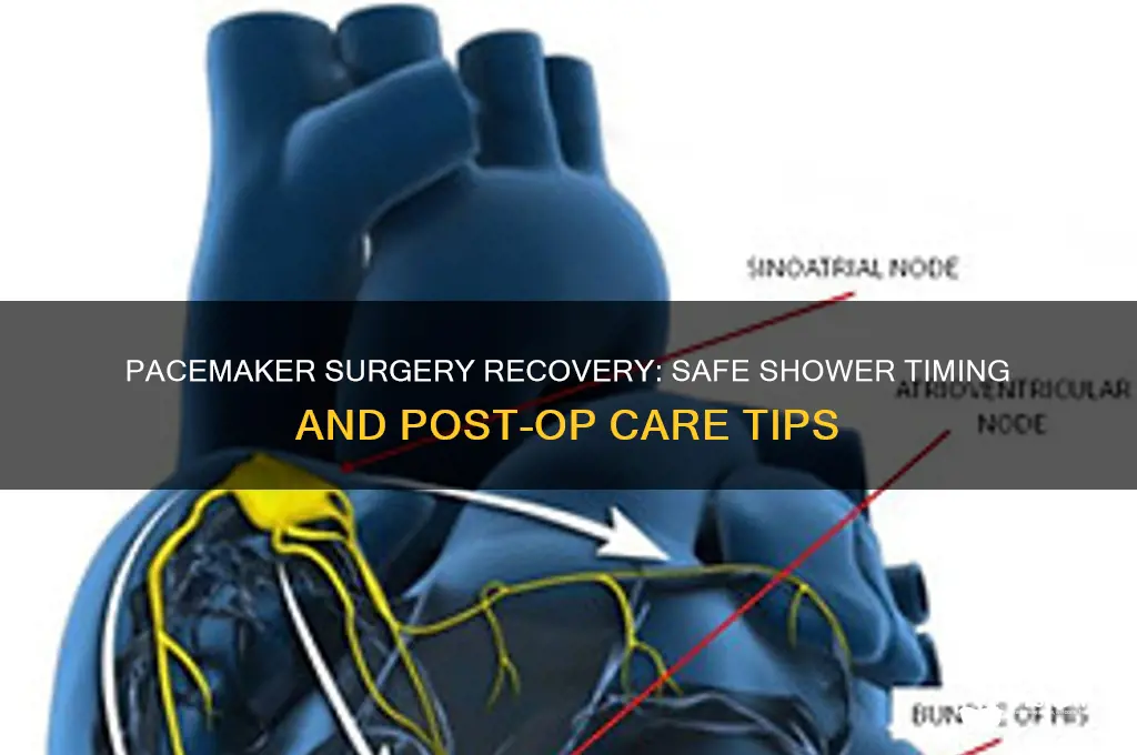 when can you take a shower after pacemaker surgery