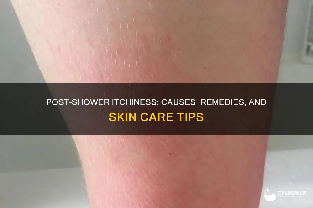 when i get out of the shower i am itchy