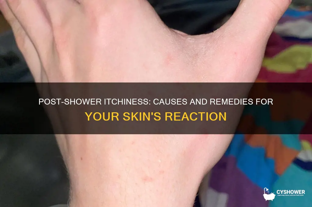 why am i itchy after i take a shower