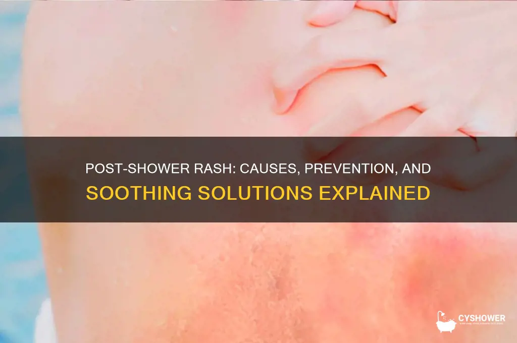 why do i get a rash after a shower