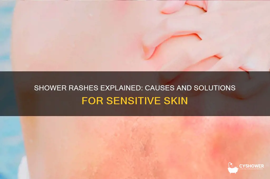 why do i get a rash every time i shower