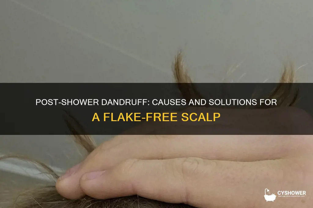why do i get dandruff after i shower