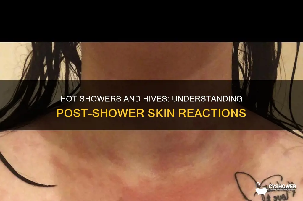 why do i get hives after a hot shower