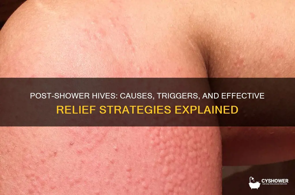 why do i get hives after a shower