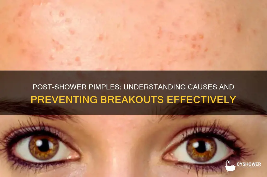 why do i get pimples after i shower