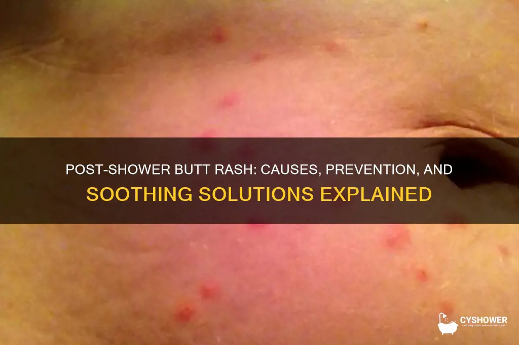 why does my ass get a rash after a shower