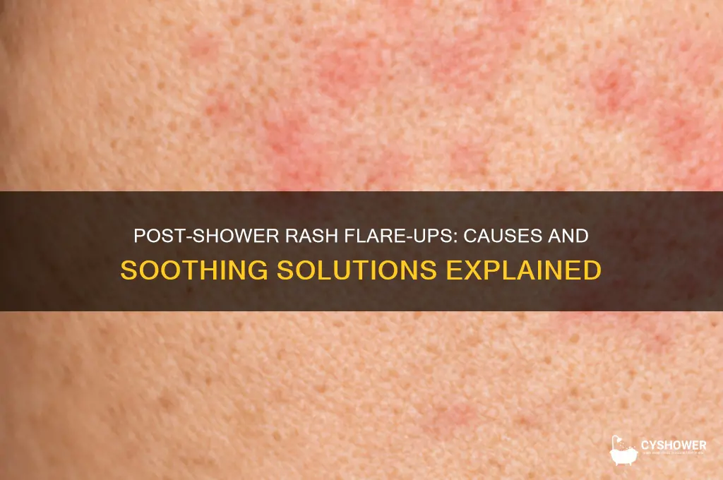 why does my rash get worse after a shower