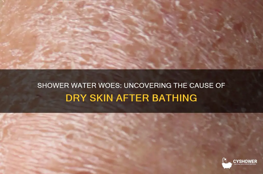 why does my shower water make my skin dry
