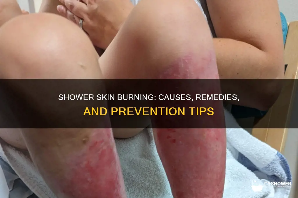 why does my skin burn when i take a shower