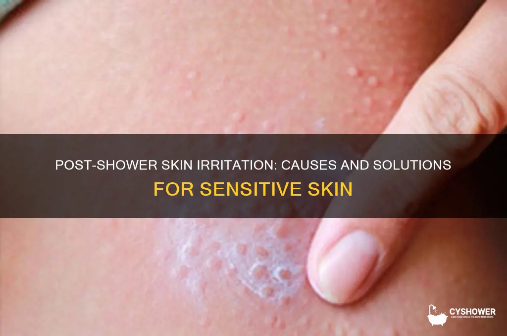 why does my skin get irritated after i shower