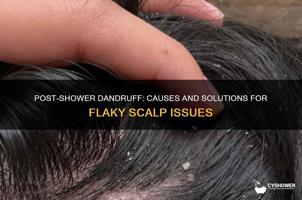 why is there dandruff in my hair after i shower