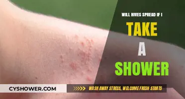 Showering with Hives: Will It Spread or Provide Relief?