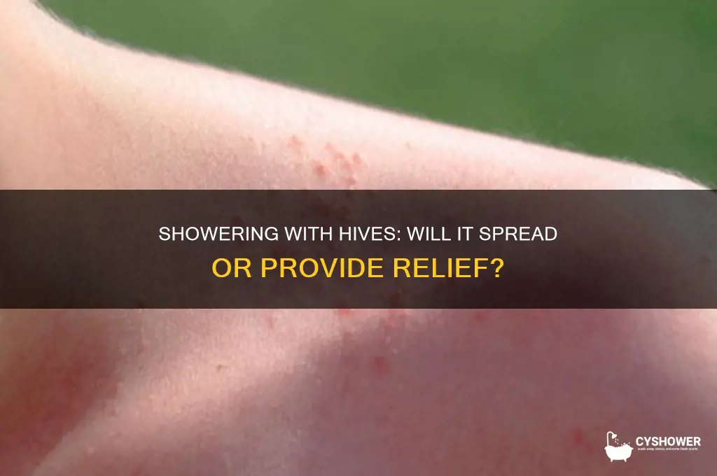 will hives spread if i take a shower